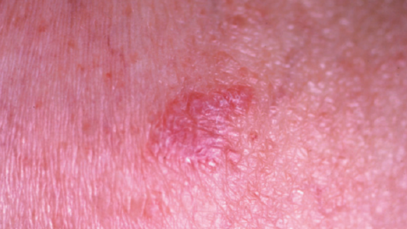 47-year-old Male With Asymptomatic Patch On Upper Arm - The Doctor's 